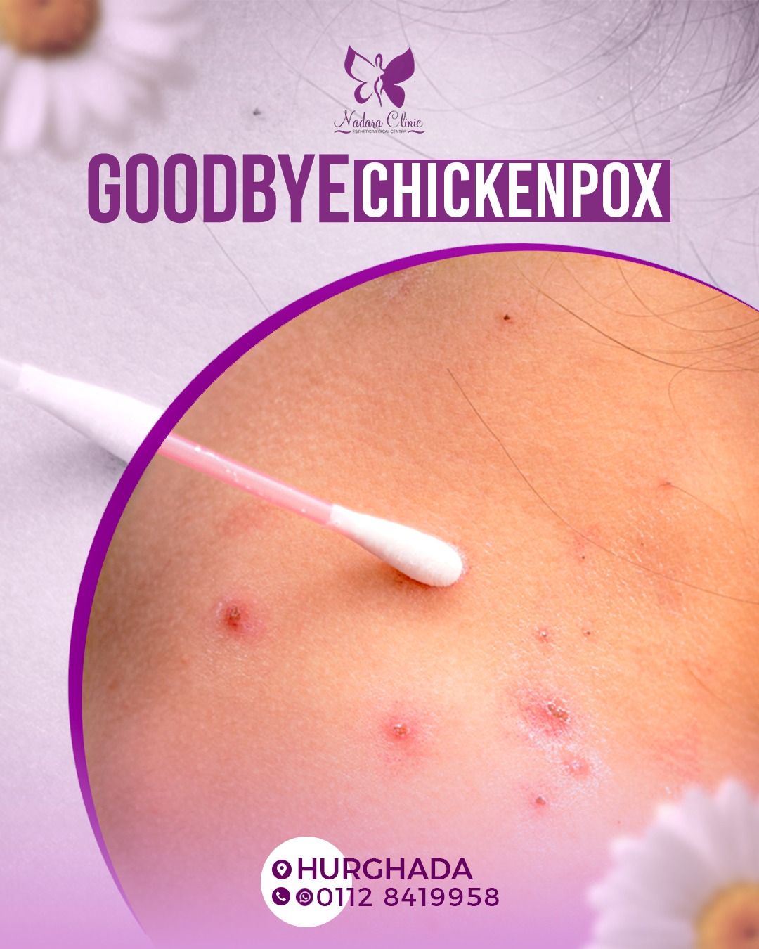 Goodbye to chickenpox in Hurghada